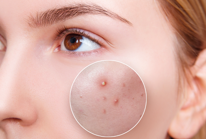 patologia ghiandole sebacee